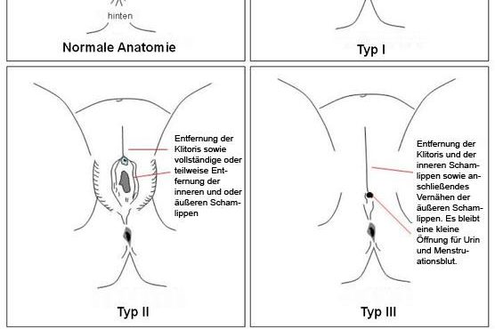 Beschneidung klitoris Female Genital